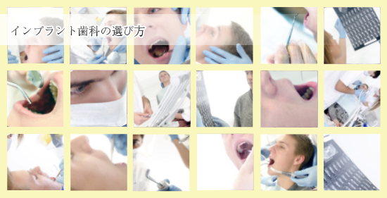 【インプラント歯科の選び方】